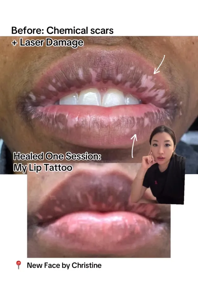 Correction & Cover-up result by New Face by Christine, NYC — photo 10