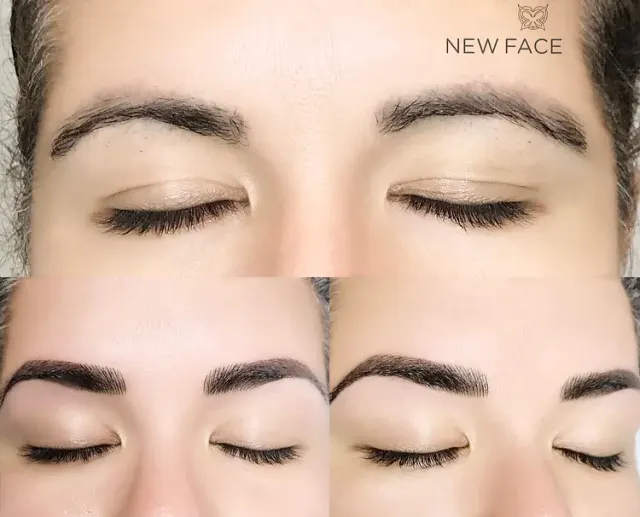 Correction & Cover-up result by New Face by Christine, NYC — photo 33