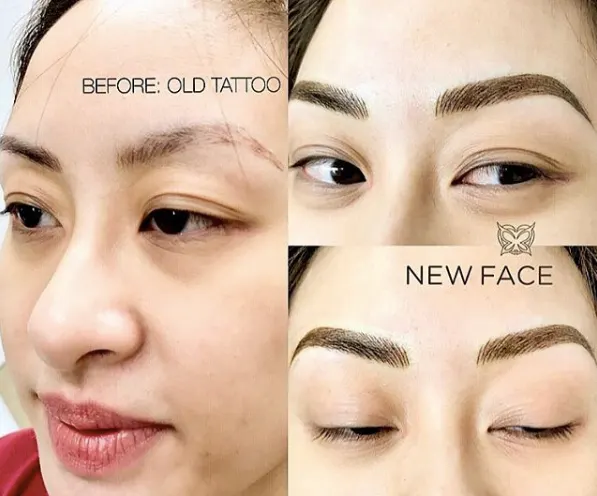 Correction & Cover-up result by New Face by Christine, NYC — photo 34