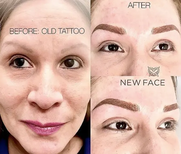Correction & Cover-up result by New Face by Christine, NYC — photo 38