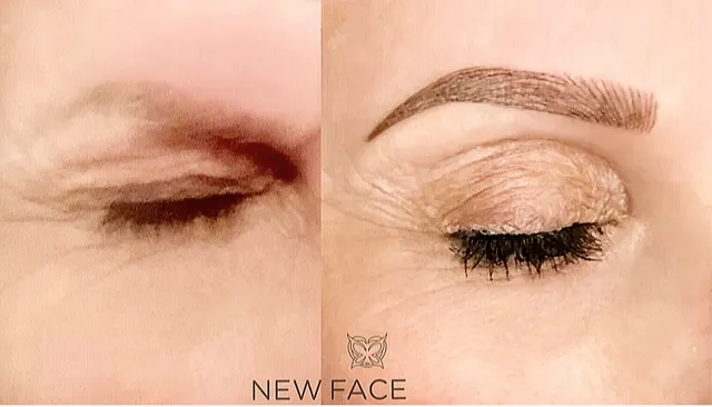 Correction & Cover-up result by New Face by Christine, NYC — photo 39