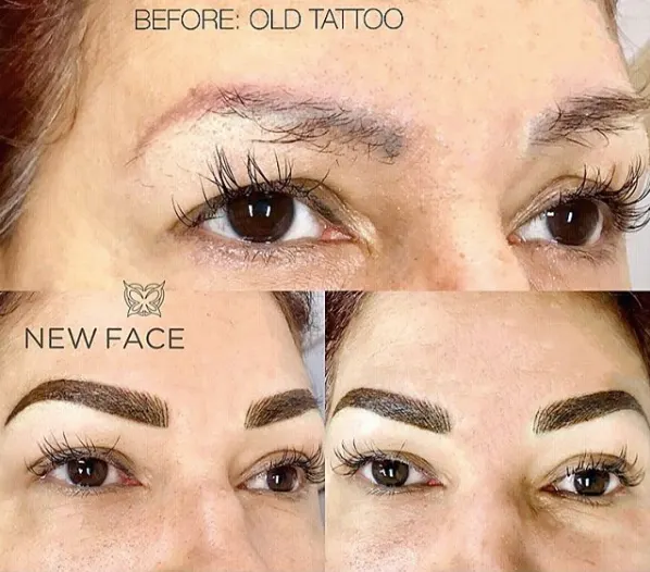 Correction & Cover-up result by New Face by Christine, NYC — photo 43