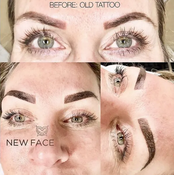 Correction & Cover-up result by New Face by Christine, NYC — photo 44