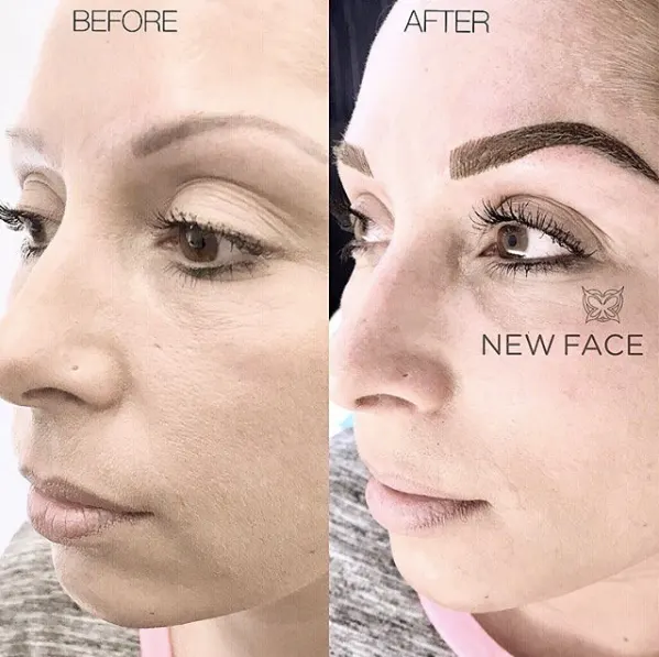 Correction & Cover-up result by New Face by Christine, NYC — photo 45
