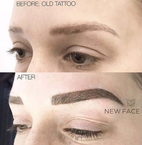 Correction & Cover-up result by New Face by Christine, NYC — photo 46