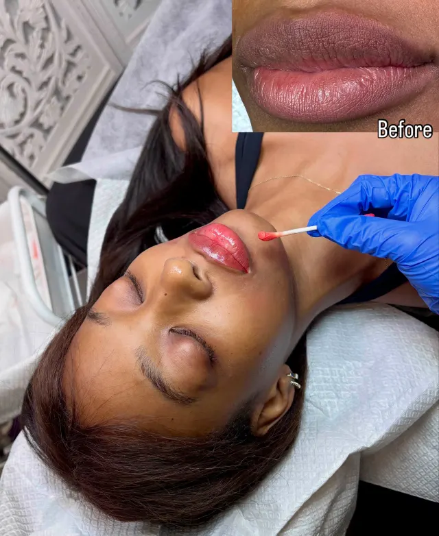 Dark Lips Neutralization result by New Face by Christine, NYC — photo 1