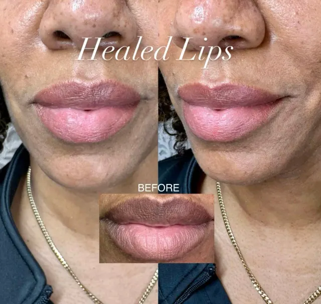 Dark Lips Neutralization result by New Face by Christine, NYC — photo 2