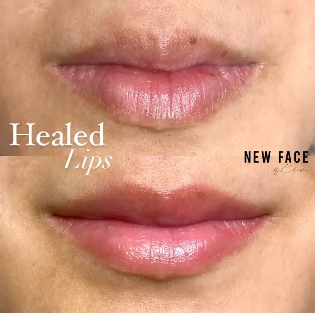 Dark Lips Neutralization result by New Face by Christine, NYC — photo 3