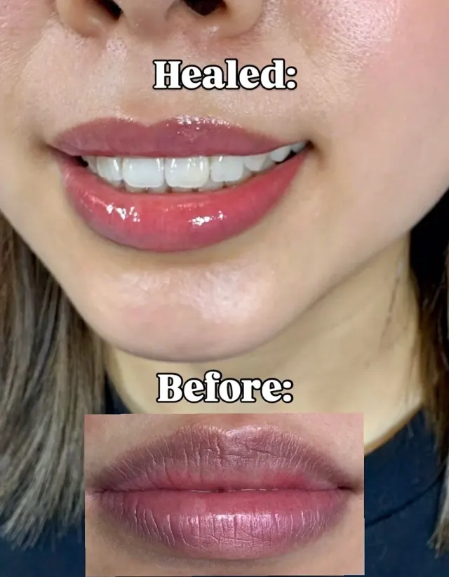 Dark Lips Neutralization result by New Face by Christine, NYC — photo 6