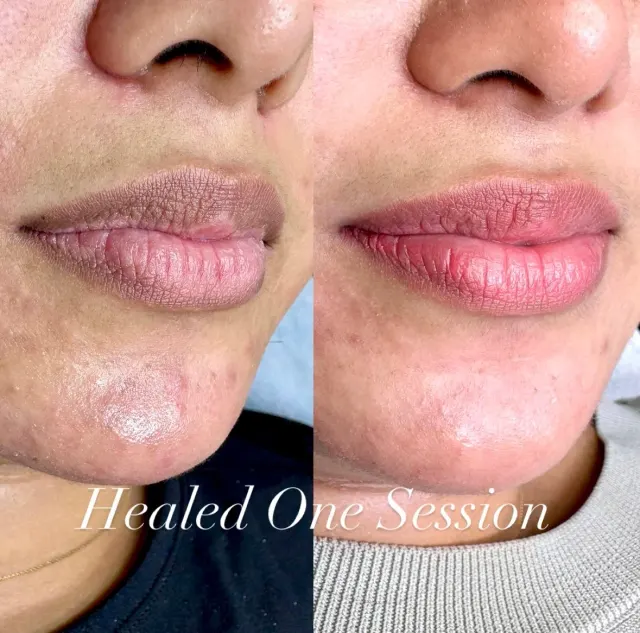 Dark Lips Neutralization result by New Face by Christine, NYC — photo 7