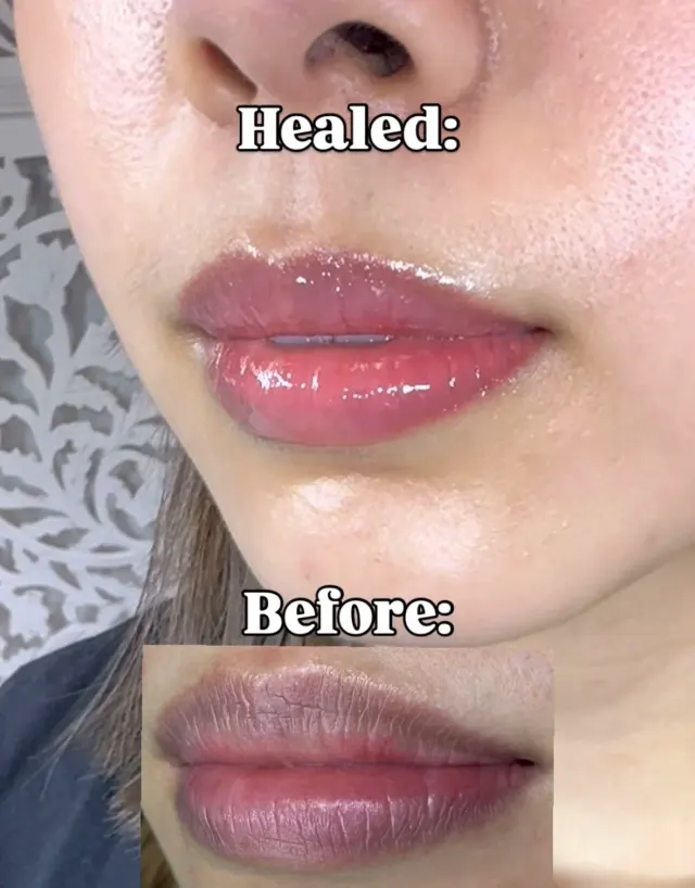 Dark Lips Neutralization result by New Face by Christine, NYC — photo 8