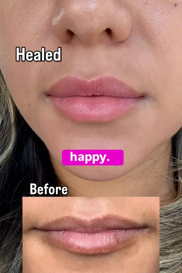 Dark Lips Neutralization result by New Face by Christine, NYC — photo 9