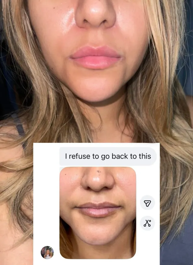 Dark Lips Neutralization result by New Face by Christine, NYC — photo 11