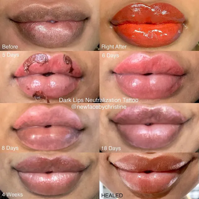 Dark Lips Neutralization result by New Face by Christine, NYC — photo 14