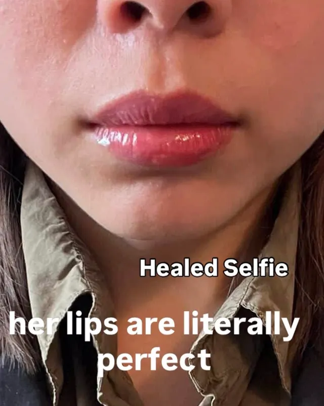 Dark Lips Neutralization result by New Face by Christine, NYC — photo 16