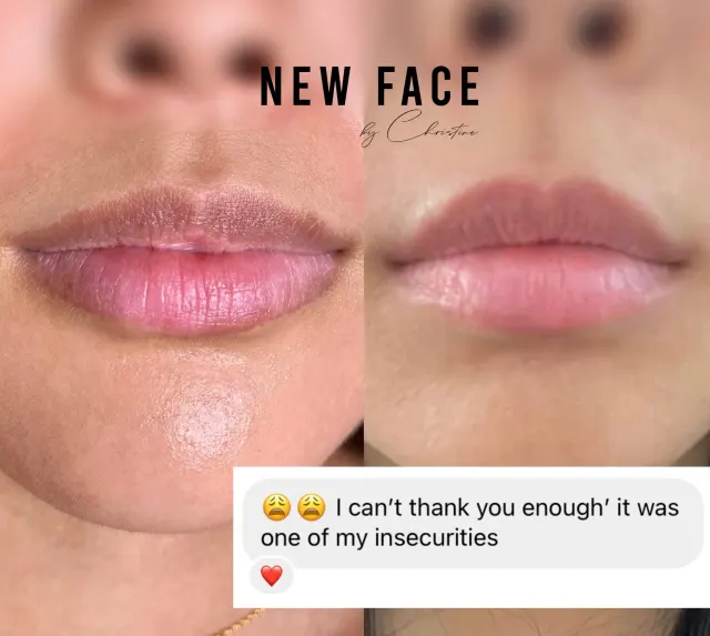 Dark Lips Neutralization result by New Face by Christine, NYC — photo 17