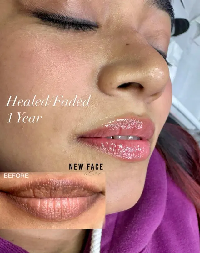 Dark Lips Neutralization result by New Face by Christine, NYC — photo 18