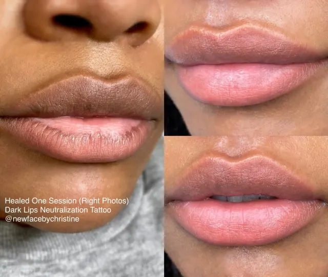 Dark Lips Neutralization result by New Face by Christine, NYC — photo 19