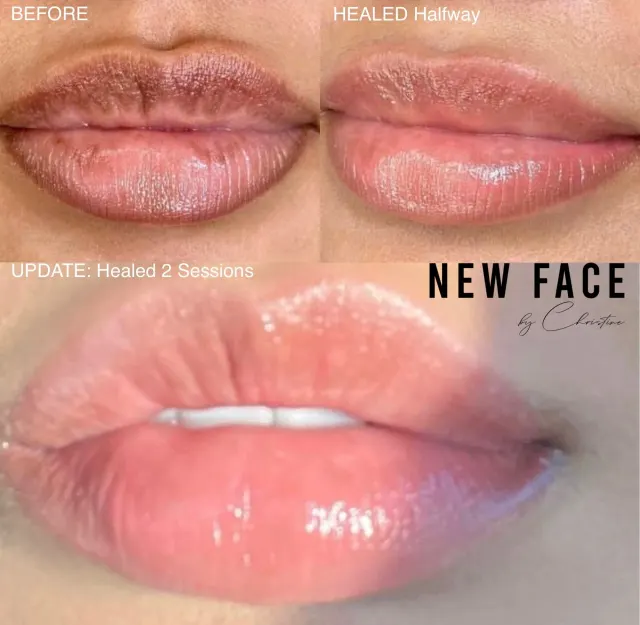 Dark Lips Neutralization result by New Face by Christine, NYC — photo 20