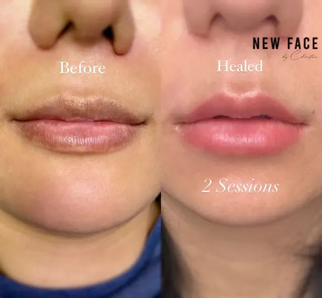 Dark Lips Neutralization result by New Face by Christine, NYC — photo 21