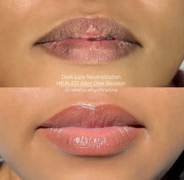 Dark Lips Neutralization result by New Face by Christine, NYC — photo 22