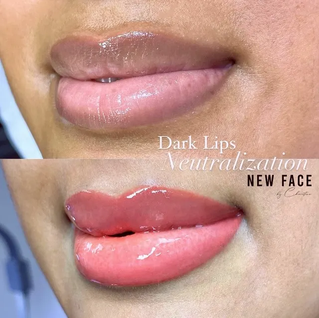 Dark Lips Neutralization result by New Face by Christine, NYC — photo 24
