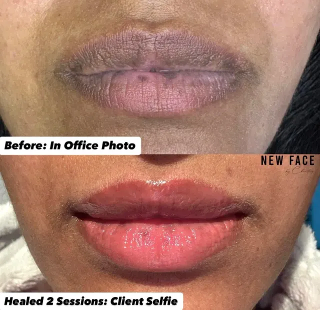 Dark Lips Neutralization result by New Face by Christine, NYC — photo 25