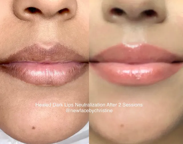 Dark Lips Neutralization result by New Face by Christine, NYC — photo 26