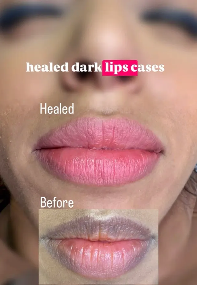 Dark Lips Neutralization result by New Face by Christine, NYC — photo 28