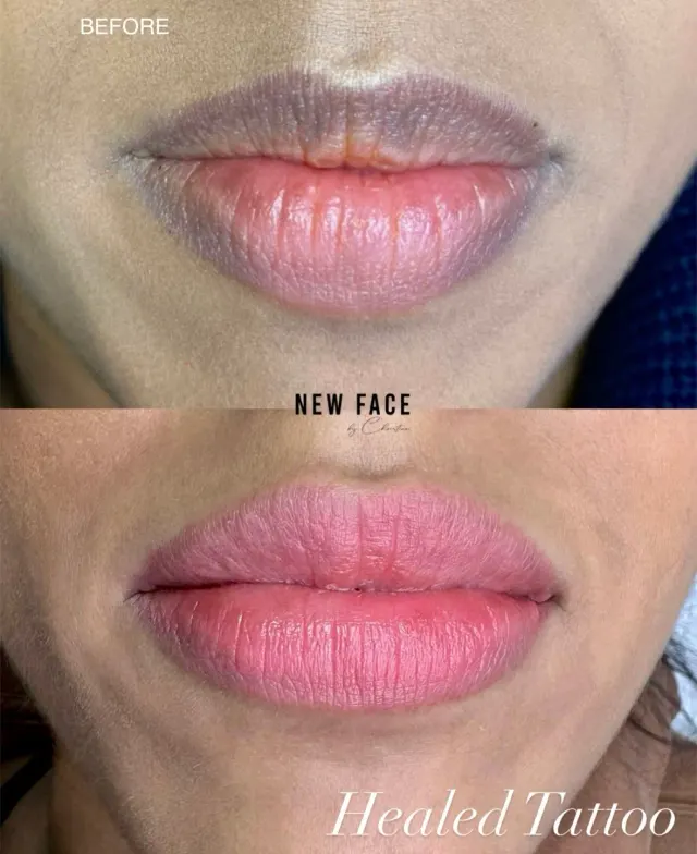Dark Lips Neutralization result by New Face by Christine, NYC — photo 29