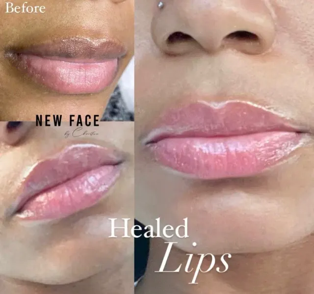 Dark Lips Neutralization result by New Face by Christine, NYC — photo 30