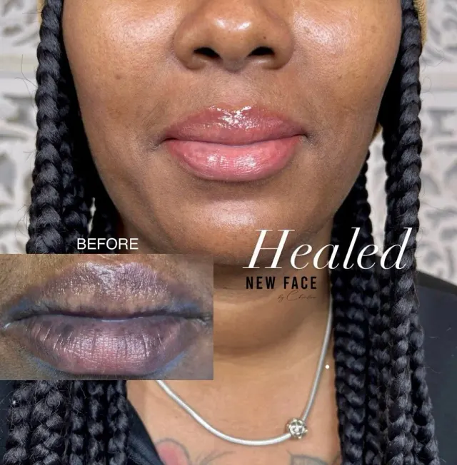 Dark Lips Neutralization result by New Face by Christine, NYC — photo 31