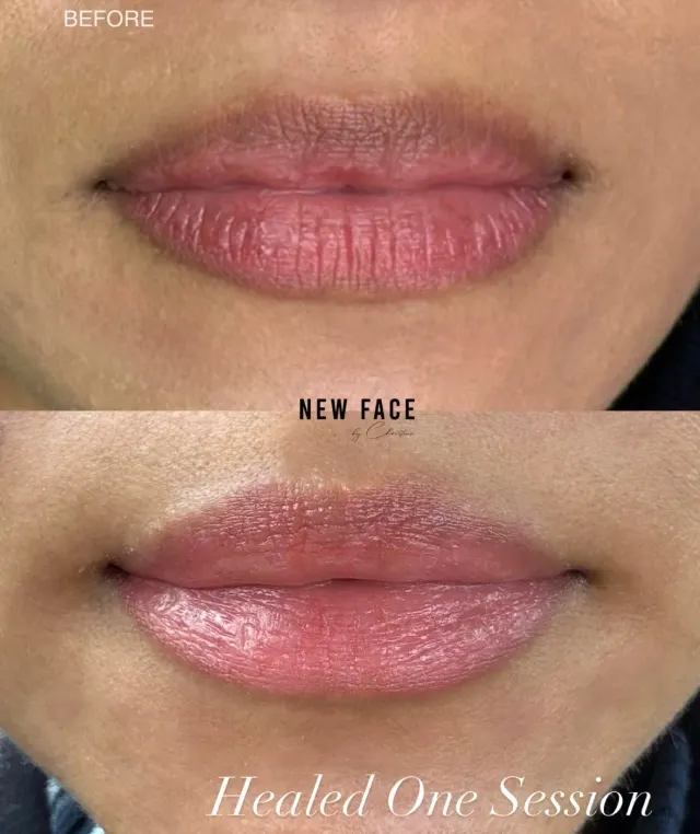 Dark Lips Neutralization result by New Face by Christine, NYC — photo 33