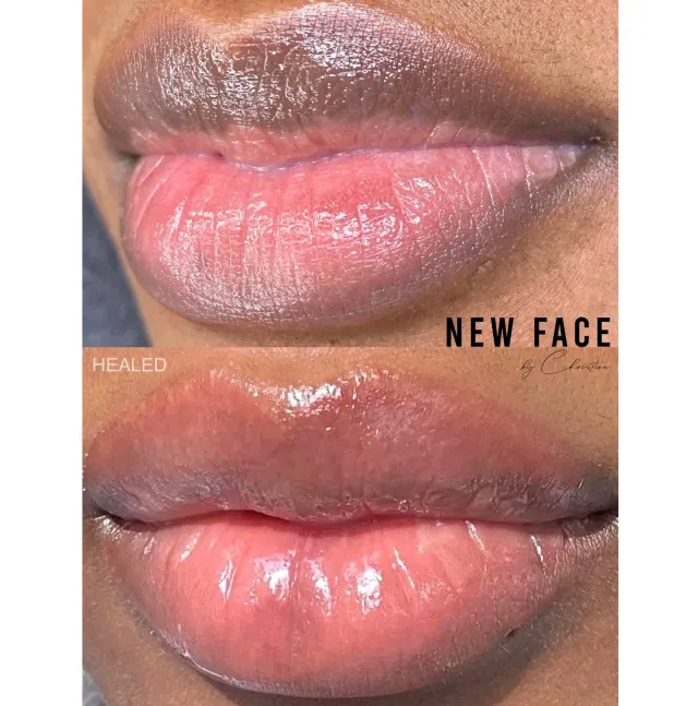 Dark Lips Neutralization result by New Face by Christine, NYC — photo 35