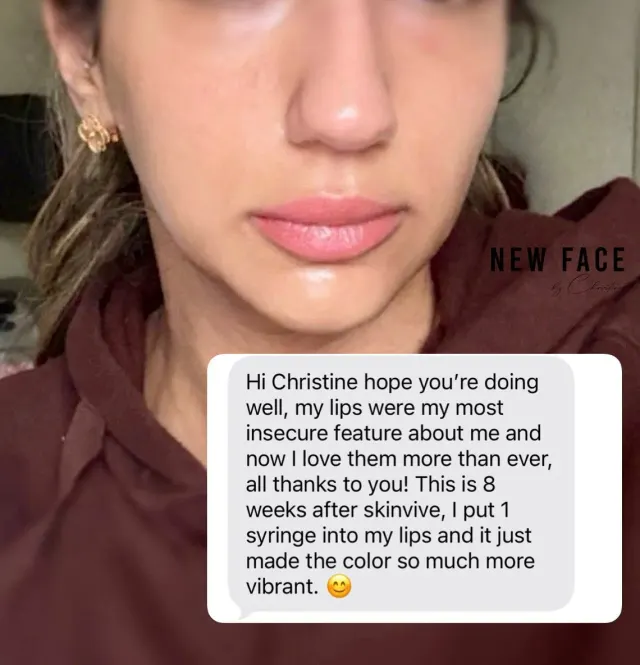Dark Lips Neutralization result by New Face by Christine, NYC — photo 37
