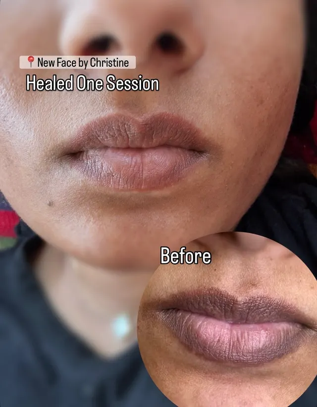 Dark Lips Neutralization result by New Face by Christine, NYC — photo 39