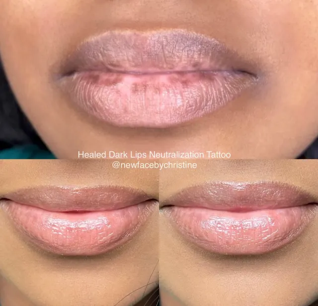 Dark Lips Neutralization result by New Face by Christine, NYC — photo 40