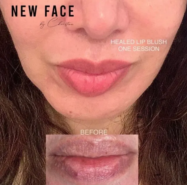 Dark Lips Neutralization result by New Face by Christine, NYC — photo 41