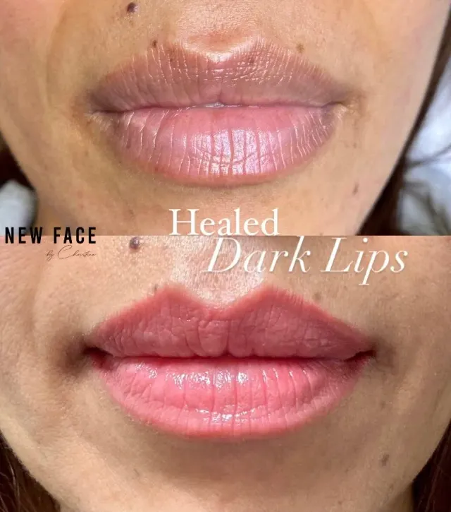 Dark Lips Neutralization result by New Face by Christine, NYC — photo 42