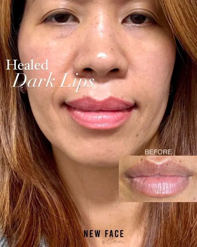 Dark Lips Neutralization result by New Face by Christine, NYC — photo 43