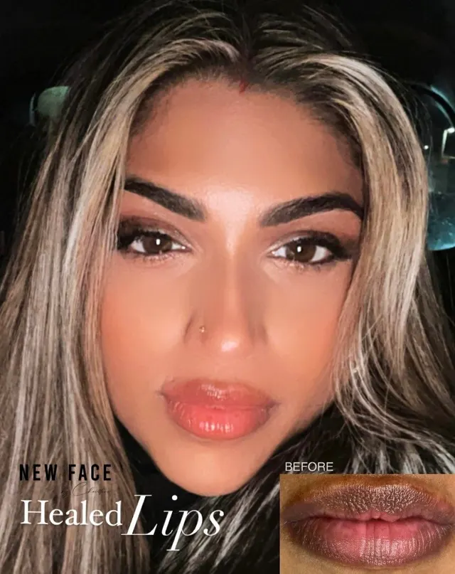 Dark Lips Neutralization result by New Face by Christine, NYC — photo 44