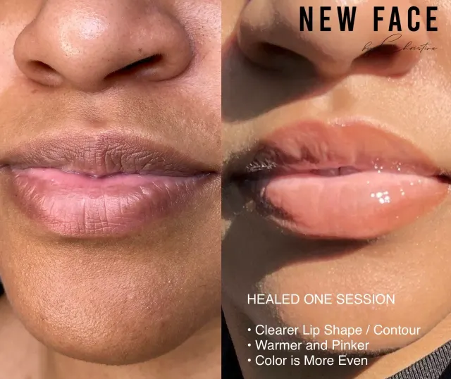 Dark Lips Neutralization result by New Face by Christine, NYC — photo 45