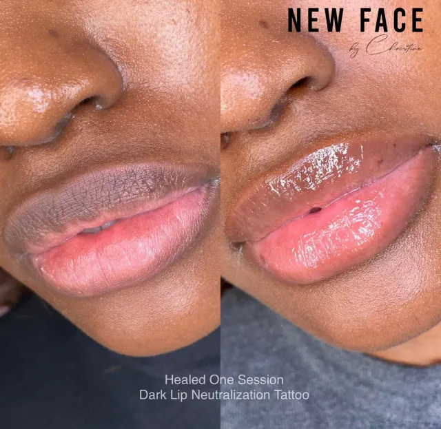 Dark Lips Neutralization result by New Face by Christine, NYC — photo 46