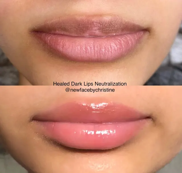 Dark Lips Neutralization result by New Face by Christine, NYC — photo 47
