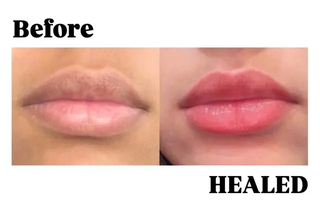 Dark Lips Neutralization result by New Face by Christine, NYC — photo 48