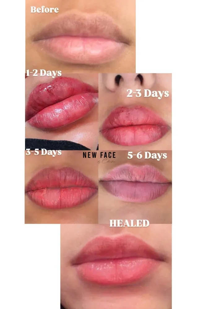 Dark Lips Neutralization result by New Face by Christine, NYC — photo 49