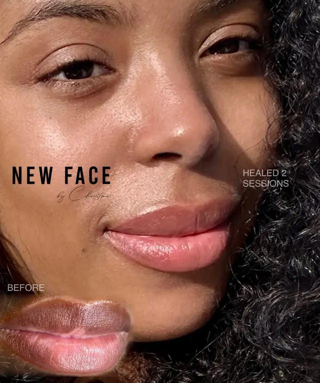 Dark Lips Neutralization result by New Face by Christine, NYC — photo 51
