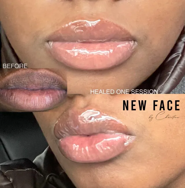 Dark Lips Neutralization result by New Face by Christine, NYC — photo 52