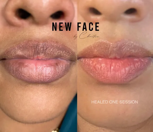 Dark Lips Neutralization result by New Face by Christine, NYC — photo 53