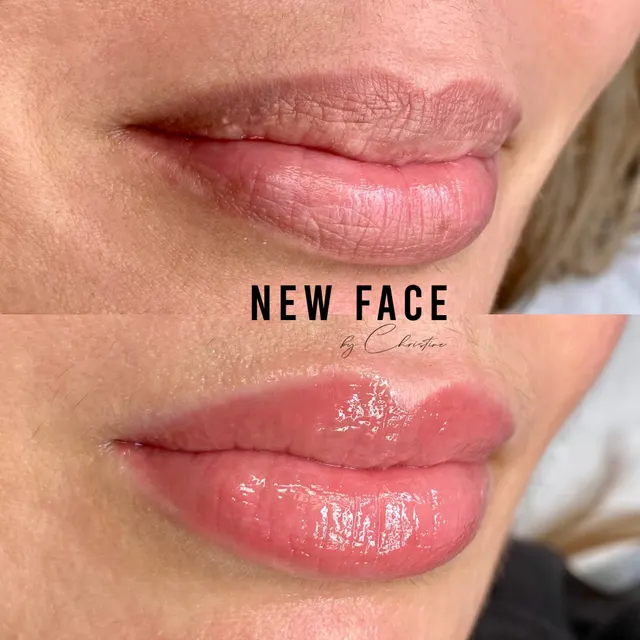 Dark Lips Neutralization result by New Face by Christine, NYC — photo 54